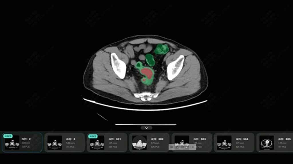 Alibaba AI cancer detection