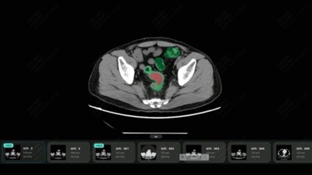 Τέλος στην κολονοσκόπηση; AI κάνει τη διάγνωση μέσω εξέτασης ρουτίνας